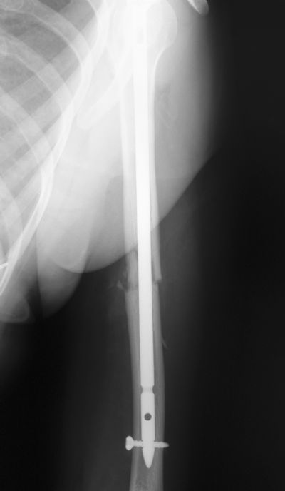 Humerus, Shaft:  Synthes Humeral Rod (Implant 228)